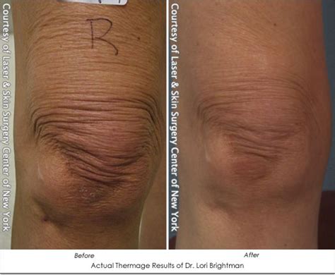 VelaShape® Overview: Cost, Recovery, Before & After .